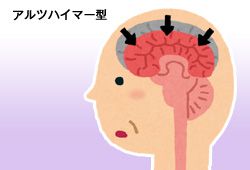 アルツハイマーのイメージ